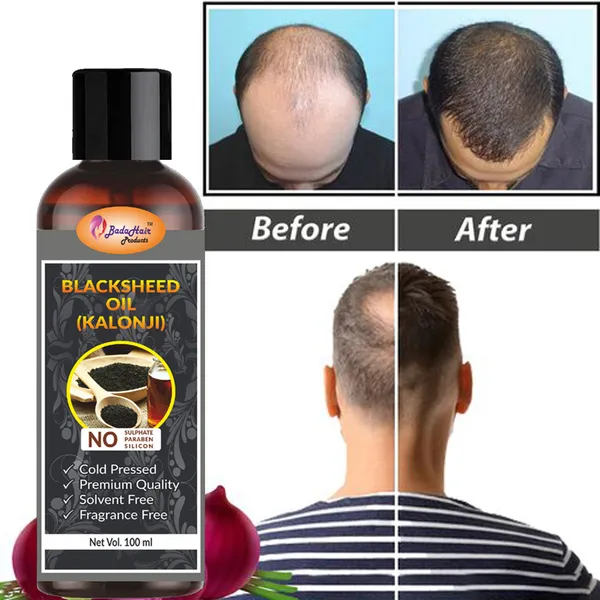 Onion_Hair_Oil_For_Hair_Regrowth_And_Hair_Fall_Control_With_Redensyl,_Pack_Of_2_(200Ml)