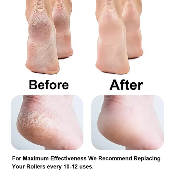 Pink_Callus_Remover_For_Feet,_Foot_Scrubber_For_Dead_Skin,_Pedicure_Kit_For_Women_For_Foot,_Pedicure_Machine,_Dead_Skin_Remover,_Foot_Scrubber,_Pedicure_Tools_For_Feet,_Foot_Scrubber_For_Dead_Skin
