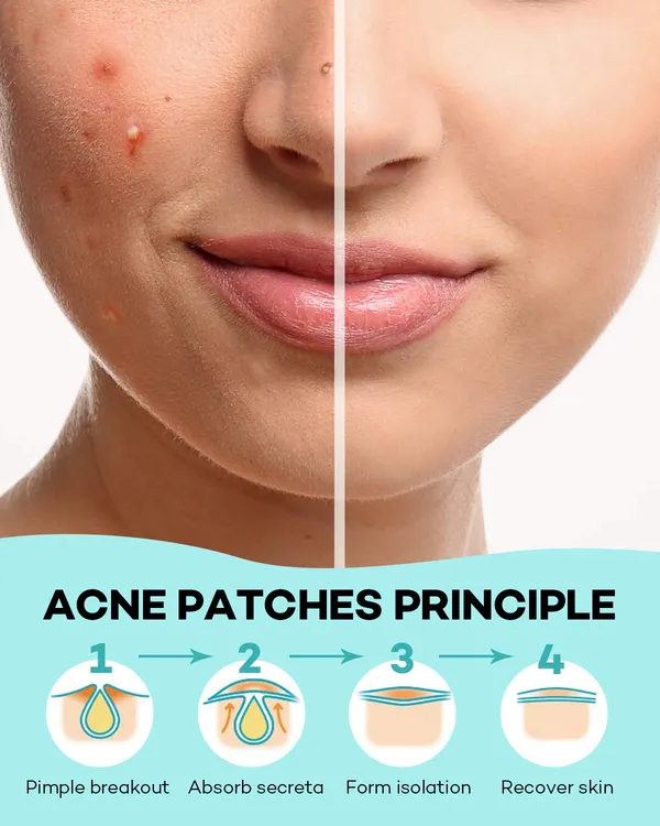 Transparent__Acne_Pimple_Patches_-_Pack_of_2_(72_Pcs)