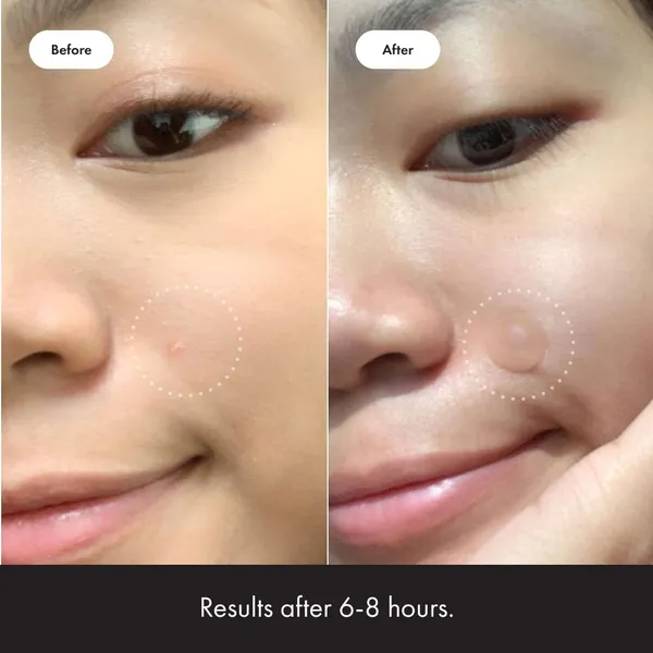 Transparent__Acne_Pimple_Patches_-_Pack_of_2_(72_Pcs)